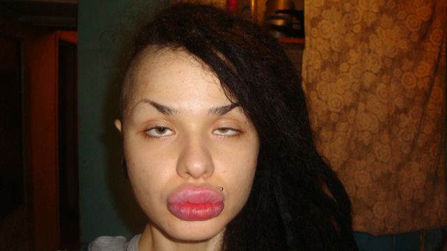 New Photos of the Girl with the World’s Largest Lips