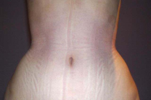 The Woman Who Is “Waisting Away” for Beauty