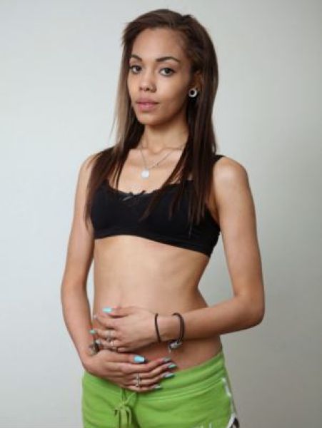 The Anorexic Pregnant Girl