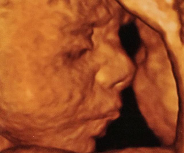 The Anorexic Pregnant Girl