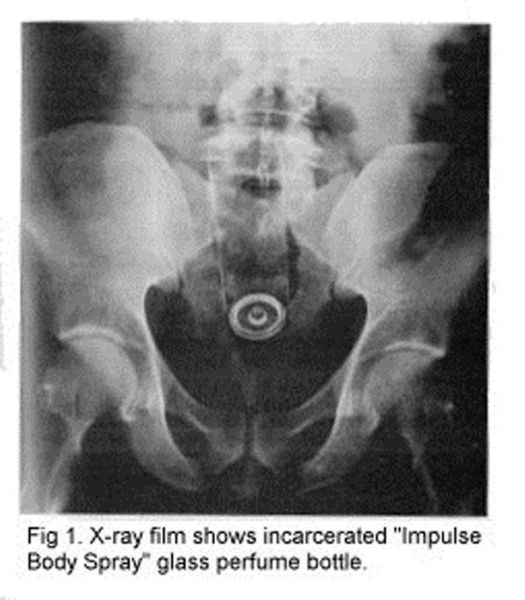 X-Rays That Prove That Horny Guys Are Idiots