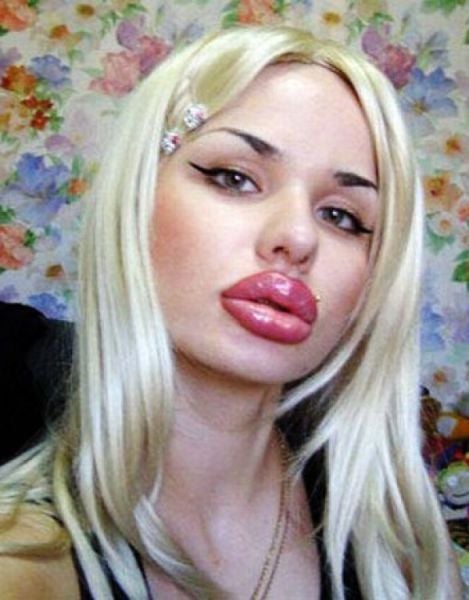 Plastic Surgery Fails That Are Just Wrong