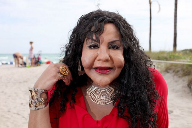 Plastic Surgery Fails That Are Just Wrong