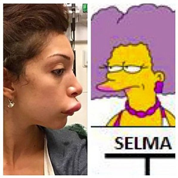 Teen Mom’s Dramatic Lip Enhancement Fail