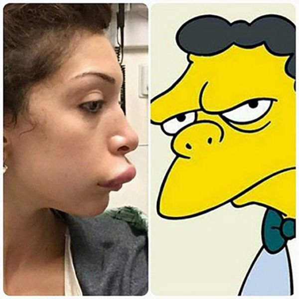 Teen Mom’s Dramatic Lip Enhancement Fail