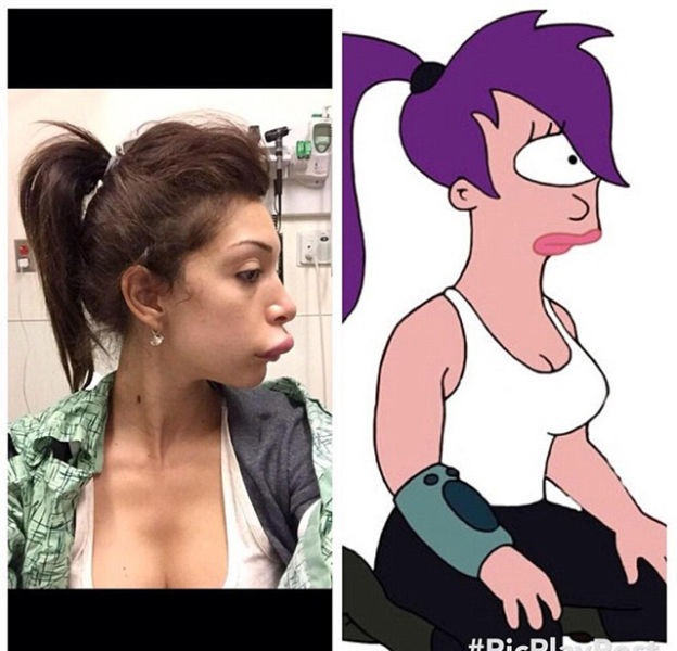 Teen Mom’s Dramatic Lip Enhancement Fail