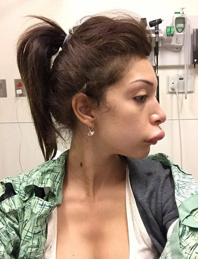 Teen Mom’s Dramatic Lip Enhancement Fail