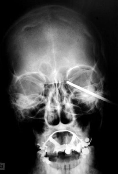 The Most Bizarre Items That Have Gotten Stuck in People’s Bodies