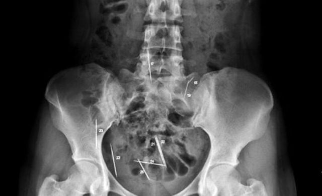 The Most Bizarre Items That Have Gotten Stuck in People’s Bodies