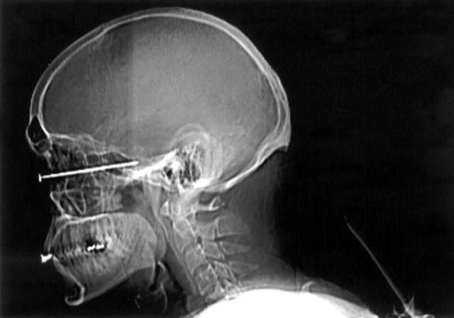 The Most Bizarre Items That Have Gotten Stuck in People’s Bodies