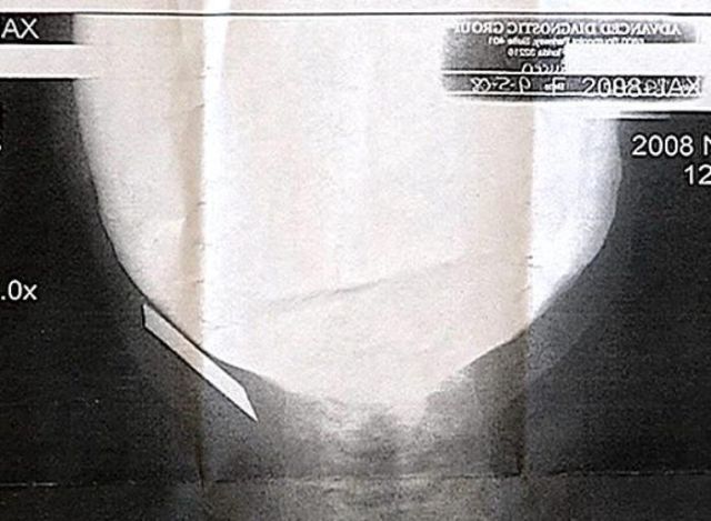 The Most Bizarre Items That Have Gotten Stuck in People’s Bodies