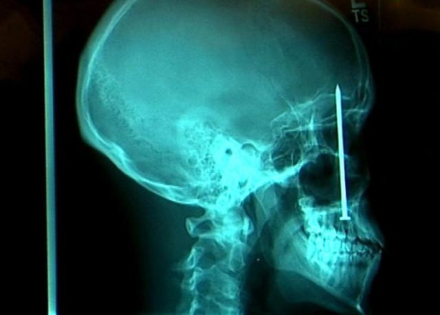 The Most Bizarre Items That Have Gotten Stuck in People’s Bodies