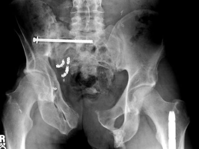 The Most Bizarre Items That Have Gotten Stuck in People’s Bodies