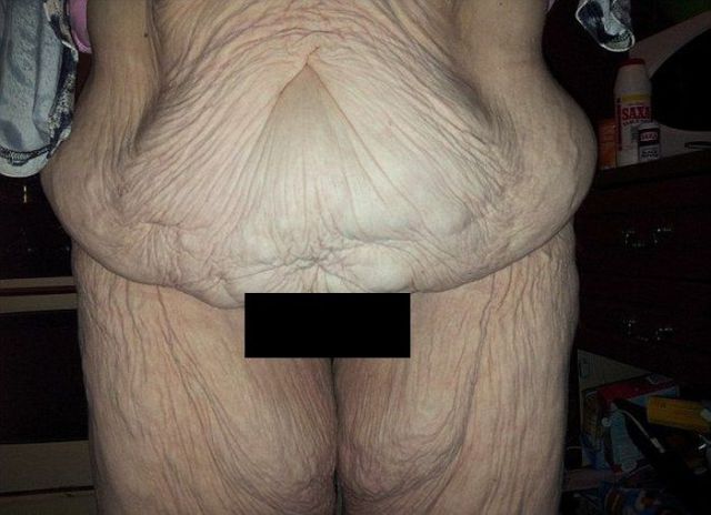 Skin Removal Operation Gives This Girl a New Body
