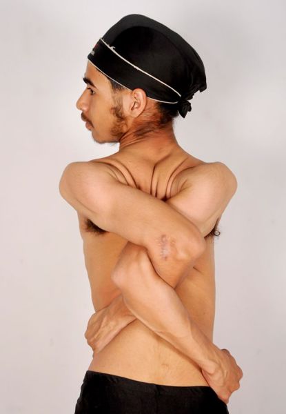 The Teenager Who Has Limbs Like Rubber